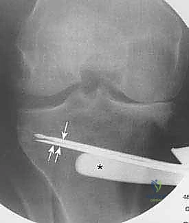 صورة توضيحية لـ عملية قطع عظم الظنبوب القاصي (HTO): إعادة محاذاة الركبة لاستعادة الحياة النشطة مع الأستاذ الدكتور محمد هطيف