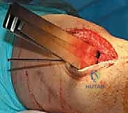 استخدام التقنيات الحديثة في جراحة العظام