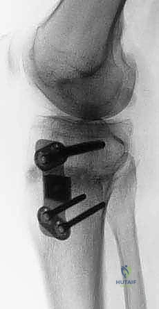 فحص الركبة السريري