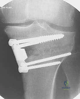 إجراء القطع العظمي بدقة