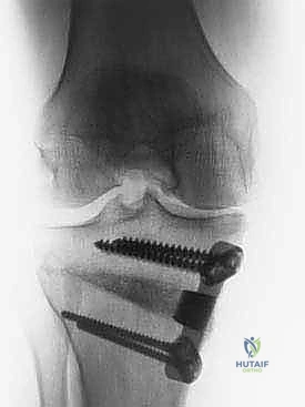 توزيع الضغط على مفصل الركبة