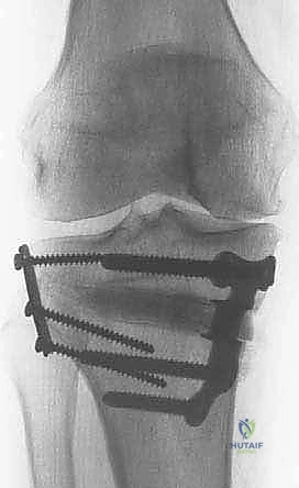 صورة توضيحية لـ عملية قطع عظم الظنبوب القاصي (HTO): إعادة محاذاة الركبة لاستعادة الحياة النشطة مع الأستاذ الدكتور محمد هطيف