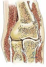 صورة مقطعية للمرفق توضح الرأس الصغير المدور والمحدب والرأس الكعبري المقعر المتطابق