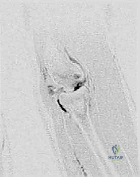 الرياضات والأنشطة التي تزيد من خطر الإصابة بالتهاب العظم والغضروف السالخ