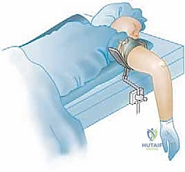 صور الأشعة السينية والرنين المغناطيسي توضح الآفة في الرأس الصغير للمرفق