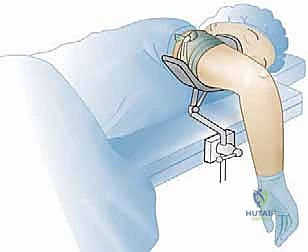 صورة توضح أماكن الألم والأعراض السريرية لالتهاب العظم والغضروف السالخ في المرفق