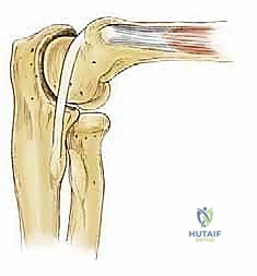 صورة توضيحية لـ تنظير مفصل المرفق لعلاج التهاب العظم والغضروف السالخ وإصابات الغضروف: دليل شامل للمرضى
