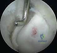 صورة توضيحية لـ تنظير مفصل المرفق لعلاج التهاب العظم والغضروف السالخ وإصابات الغضروف: دليل شامل للمرضى