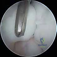 الخطوة الجراحية الأولى: استكشاف المفصل بالمنظار وتحديد موقع الآفة بدقة