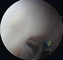 العلاج التحفظي واستخدام الدعامات في مراحل الإصابة المبكرة