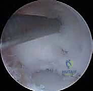 Illustration of proximal anteromedial portal - Dr. Mohammed Hutaif