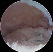 صورة توضيحية لـ تنظير مفصل المرفق لعلاج التهاب العظم والغضروف السالخ وإصابات الغضروف: دليل شامل للمرضى