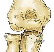 صورة توضيحية لـ تنظير مفصل المرفق لعلاج التهاب العظم والغضروف السالخ وإصابات الغضروف: دليل شامل للمرضى