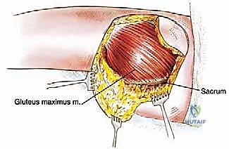 استئصال الورم اللحمي من العضلة الألوية الكبرى مع الحفاظ على الأطراف: دليل شامل للمرضى