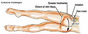 Limb-Sparing Gluteus Maximus Resection for Sarcoma: An Intraoperative Masterclass