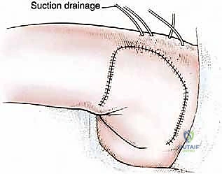 خطوات جراحة استئصال الورم من العضلة الألوية