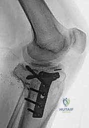 فتح المفصل والتقييم