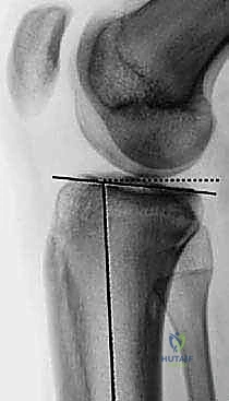 استبدال مفصل الركبة الكلي بالإسمنت: حل دائم لآلام الركبة المزمنة في صنعاء مع الأستاذ الدكتور محمد هطيف