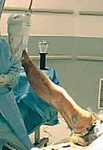 تحضير الإسمنت العظمي