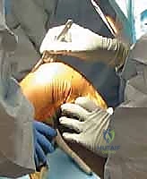 تقييم حالة الركبة قبل الجراحة