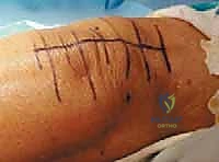 صورة طبية: استبدال مفصل الركبة الكلي بالإسمنت: حل دائم لآلام الركبة المزمنة في صنعاء مع الأستاذ الدكتور محمد هطيف