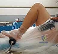 إزالة الزوائد العظمية