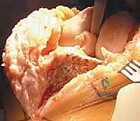 صورة طبية: استبدال مفصل الركبة الكلي بالإسمنت: حل دائم لآلام الركبة المزمنة في صنعاء مع الأستاذ الدكتور محمد هطيف