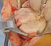 صورة توضيحية لـ استبدال مفصل الركبة الكلي بالإسمنت: حل دائم لآلام الركبة المزمنة في صنعاء مع الأستاذ الدكتور محمد هطيف