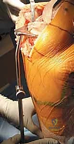 التخطيط ما قبل الجراحة