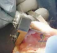 التأكد من استقامة الساق