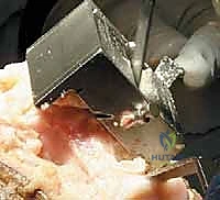 صورة توضيحية لـ استبدال مفصل الركبة الكلي بالإسمنت: حل دائم لآلام الركبة المزمنة في صنعاء مع الأستاذ الدكتور محمد هطيف