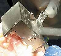 أدلة القطع لقصبة الساق