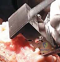 صورة طبية: استبدال مفصل الركبة الكلي بالإسمنت: حل دائم لآلام الركبة المزمنة في صنعاء مع الأستاذ الدكتور محمد هطيف