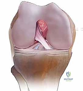 صورة طبية: استبدال مفصل الركبة الكلي بالإسمنت: حل دائم لآلام الركبة المزمنة في صنعاء مع الأستاذ الدكتور محمد هطيف