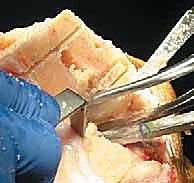 صورة توضيحية لـ استبدال مفصل الركبة الكلي بالإسمنت: حل دائم لآلام الركبة المزمنة في صنعاء مع الأستاذ الدكتور محمد هطيف