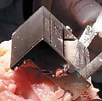 صورة طبية: استبدال مفصل الركبة الكلي بالإسمنت: حل دائم لآلام الركبة المزمنة في صنعاء مع الأستاذ الدكتور محمد هطيف