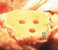 صورة طبية: استبدال مفصل الركبة الكلي بالإسمنت: حل دائم لآلام الركبة المزمنة في صنعاء مع الأستاذ الدكتور محمد هطيف