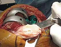 صورة توضيحية لـ استبدال مفصل الركبة الكلي بالإسمنت: حل دائم لآلام الركبة المزمنة في صنعاء مع الأستاذ الدكتور محمد هطيف