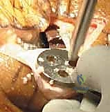 التحضير النهائي لعظم الفخذ