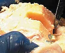 صورة طبية: استبدال مفصل الركبة الكلي بالإسمنت: حل دائم لآلام الركبة المزمنة في صنعاء مع الأستاذ الدكتور محمد هطيف