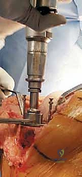 صورة توضيحية لـ استبدال مفصل الركبة الكلي بالإسمنت: حل دائم لآلام الركبة المزمنة في صنعاء مع الأستاذ الدكتور محمد هطيف