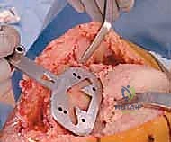 صورة طبية: استبدال مفصل الركبة الكلي بالإسمنت: حل دائم لآلام الركبة المزمنة في صنعاء مع الأستاذ الدكتور محمد هطيف