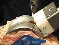 صورة طبية: استبدال مفصل الركبة الكلي بالإسمنت: حل دائم لآلام الركبة المزمنة في صنعاء مع الأستاذ الدكتور محمد هطيف