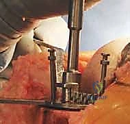 صورة طبية: استبدال مفصل الركبة الكلي بالإسمنت: حل دائم لآلام الركبة المزمنة في صنعاء مع الأستاذ الدكتور محمد هطيف