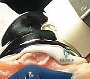 صورة طبية: استبدال مفصل الركبة الكلي بالإسمنت: حل دائم لآلام الركبة المزمنة في صنعاء مع الأستاذ الدكتور محمد هطيف