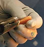 Illustration of cemented tka figure - Dr. Mohammed Hutaif