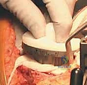 القطع العظمي الدقيق للفخذ