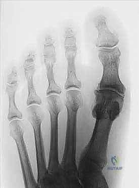 تشخيص خشونة مفصل إبهام القدم الكبير