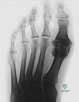 أسباب وعوامل خطر إبهام القدم المتيبس