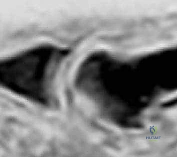 أعراض خشونة مفصل المشط السلامي الأول